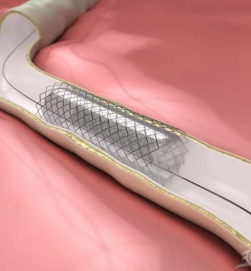 心臟支架并非一勞永逸術后要注意規(guī)范用藥定期復診