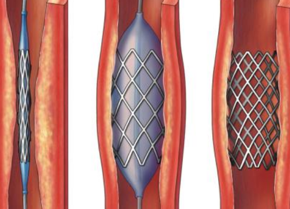 好消息！700元冠脈支架來(lái)了帶量采購(gòu)結(jié)果在甘肅省正式落地執(zhí)行